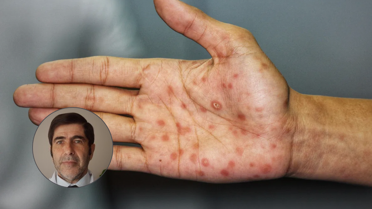 Alerta por los casos de sífilis