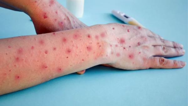 viruela símica (mpox)