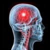 Accidente Cerebro Vascular