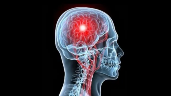 Accidente Cerebro Vascular