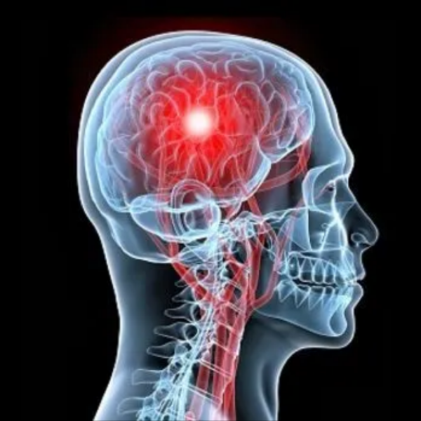 Accidente Cerebro Vascular